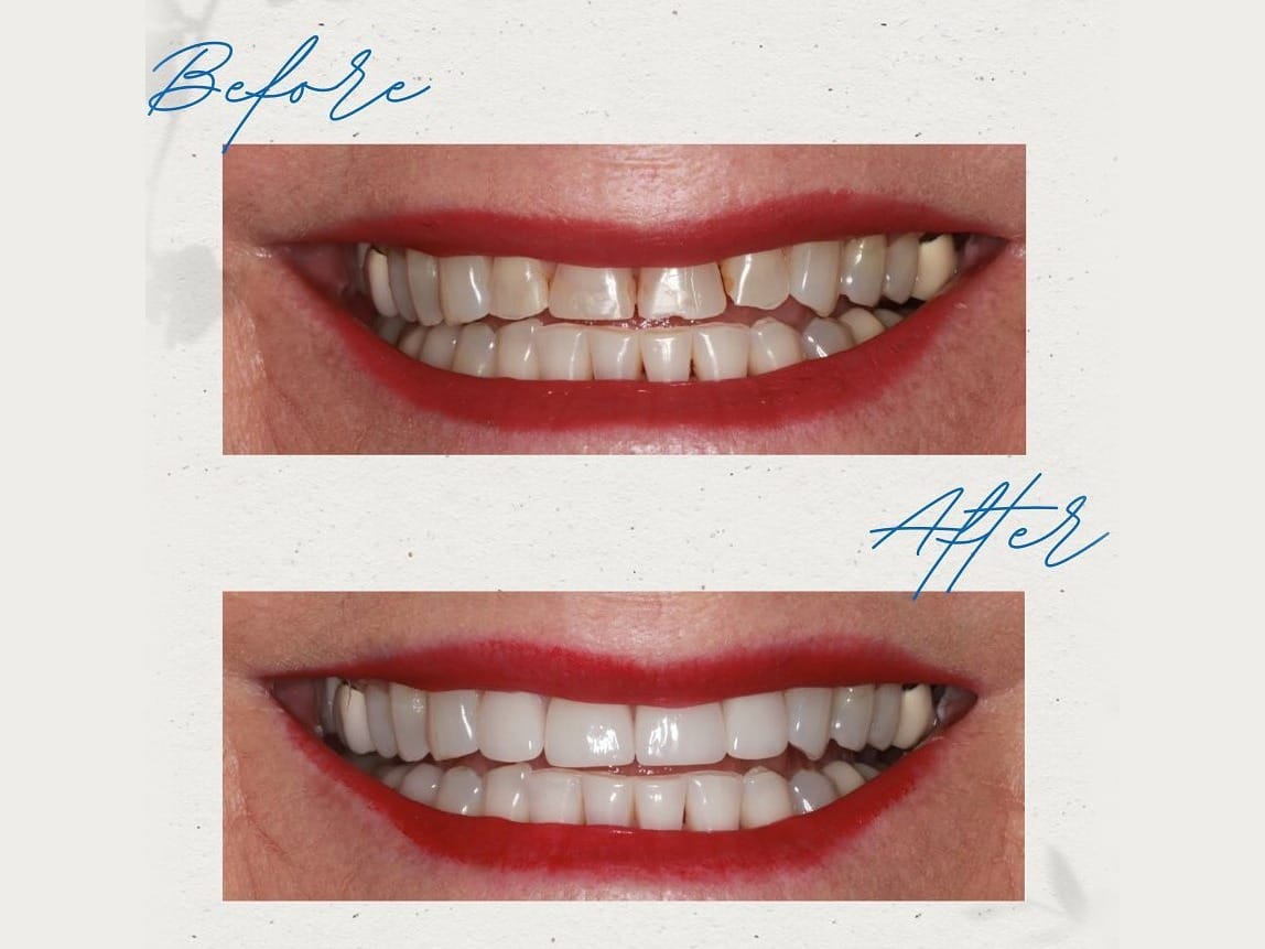 Before and after veneers