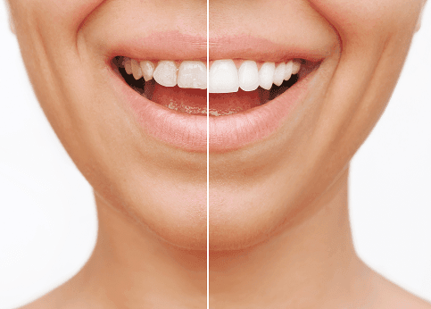 Before and after veneers treatment