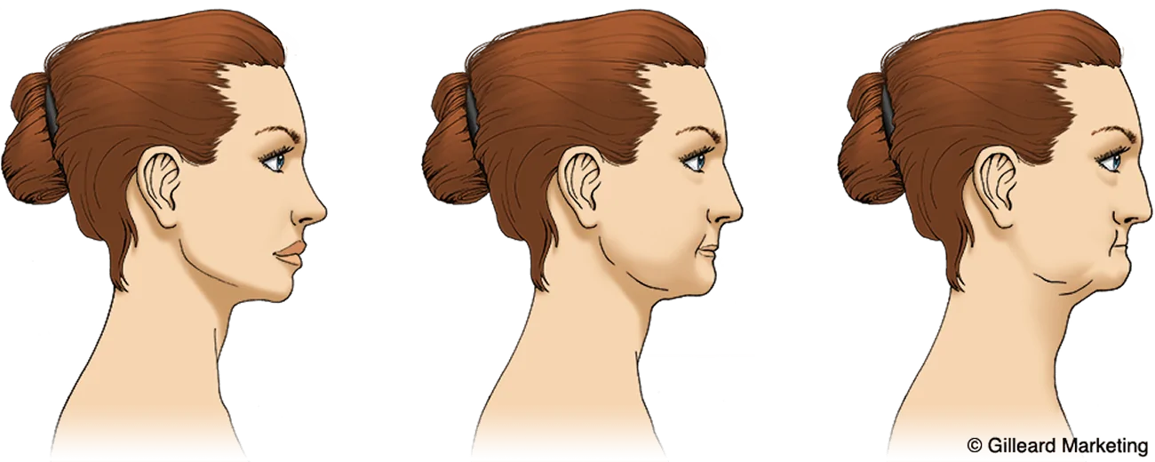 Jaw bone reduction diagram