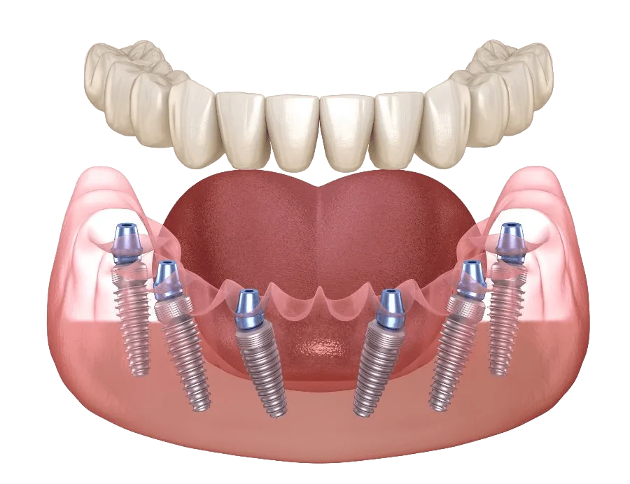 Stabili-Teeth diagram