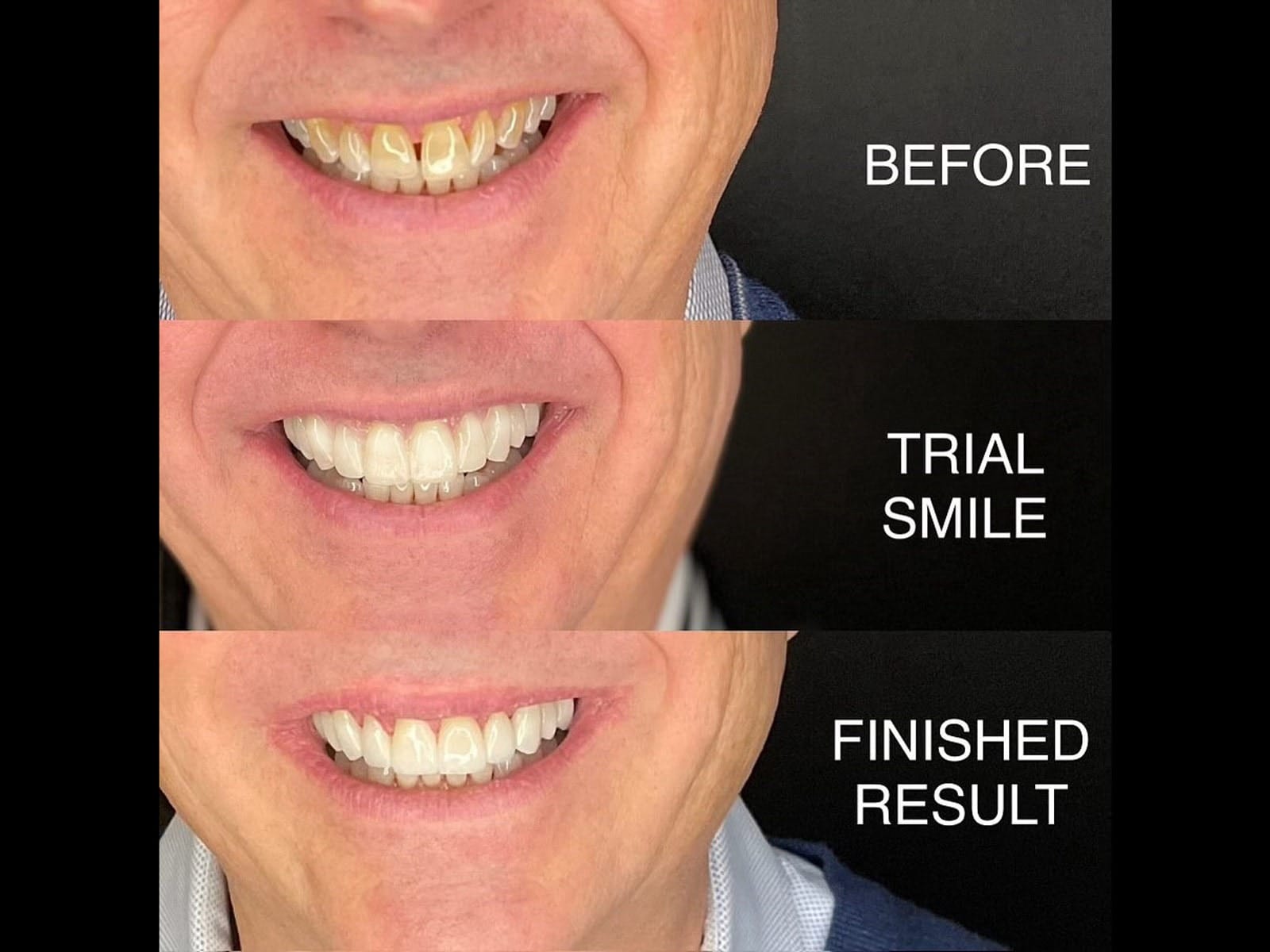 Before and after a trial smile