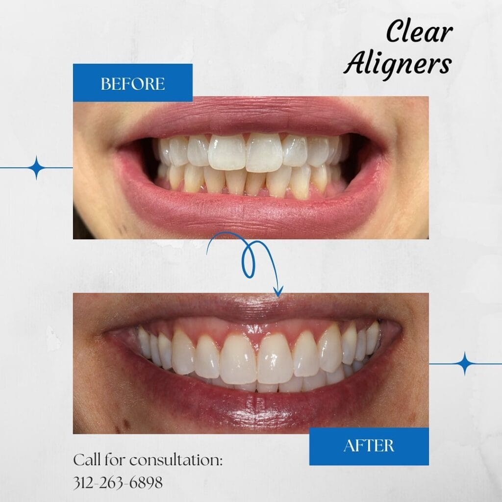 Before and after clear aligners treatment