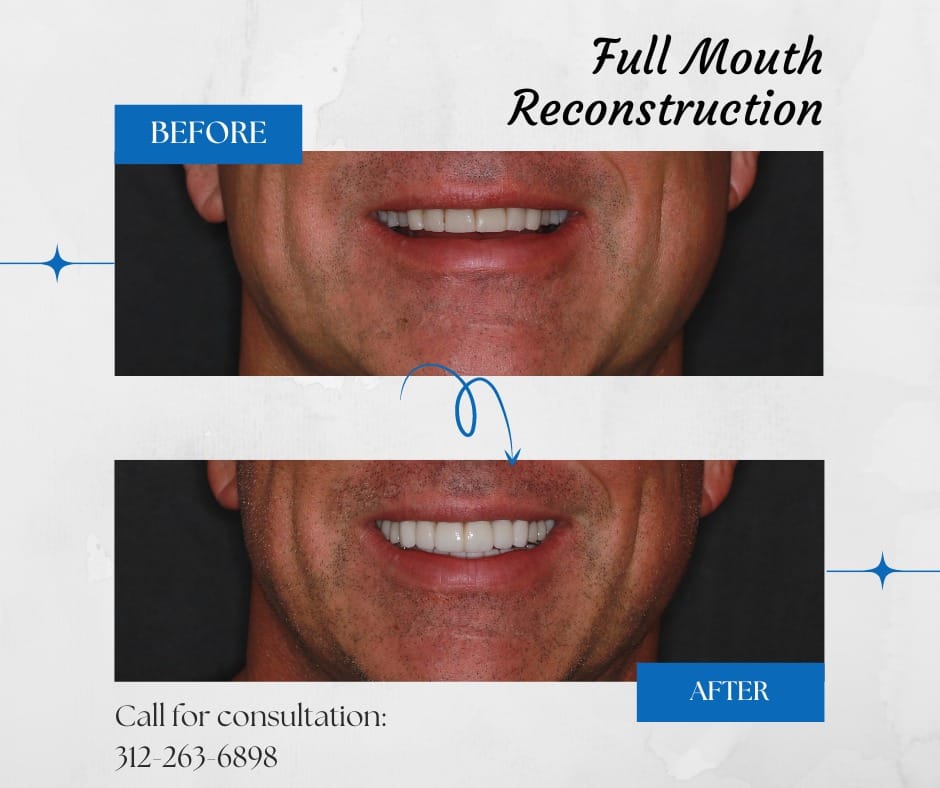 Before and after dental reconstruction.