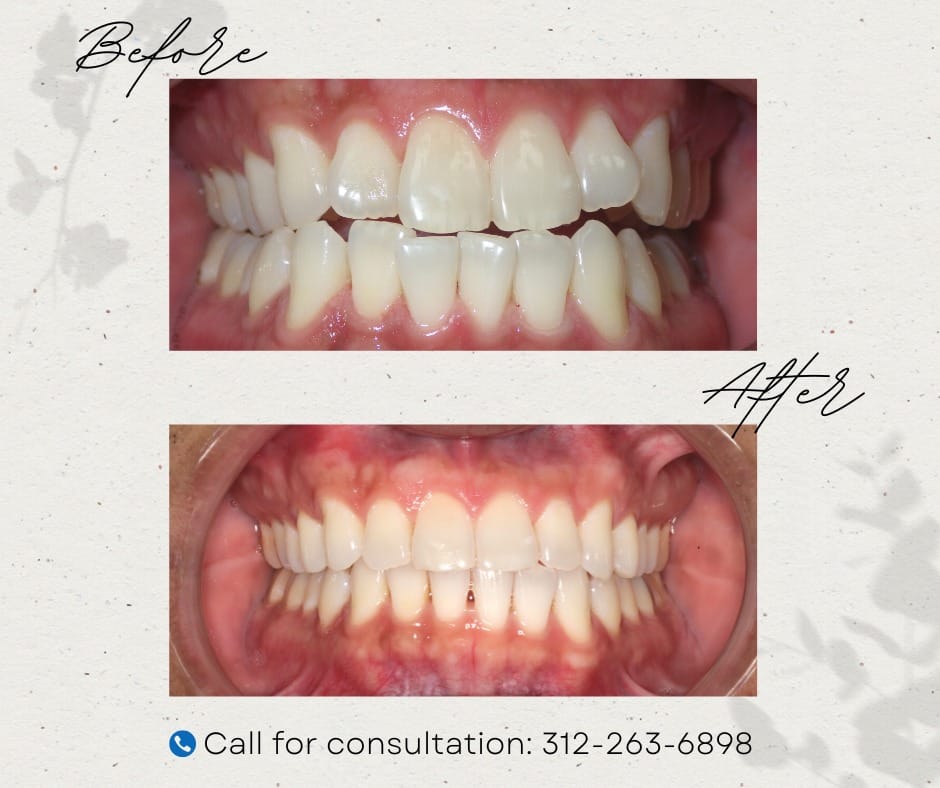 Teeth whitening before and after results