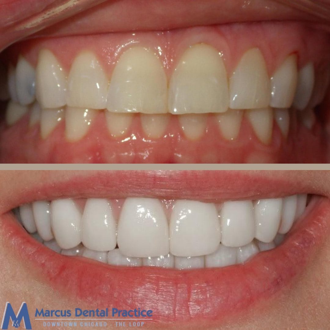 Before and after teeth whitening treatment